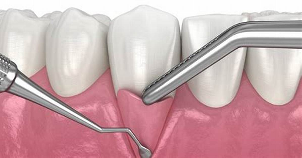 Is There an Alternative to Gum Grafting?