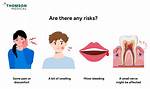 Is There Any Risk in Biopsy?