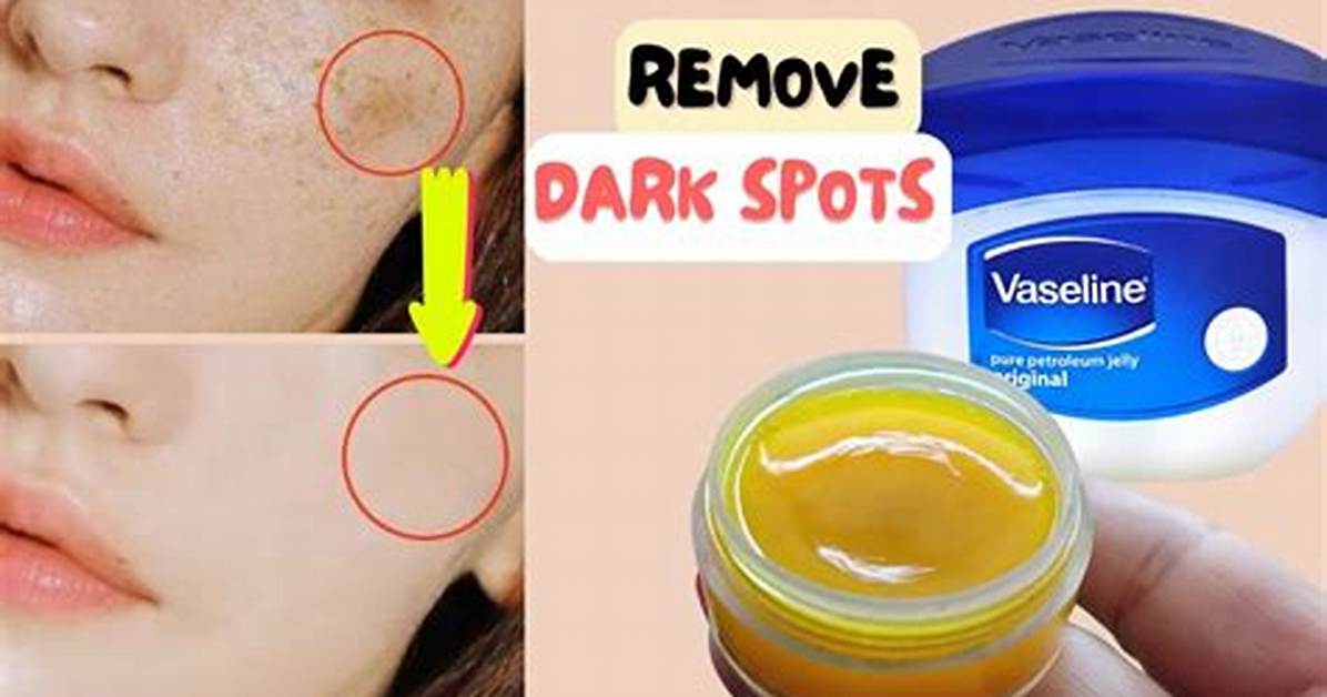 Is Vaseline Good for Pimples?