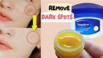 Is Vaseline Good for Pimples?