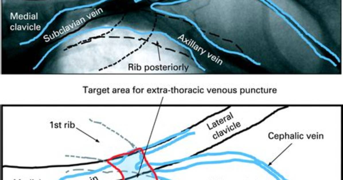 Is Venography Included in Pacemaker Insertion?