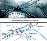 Is Venography Included in Pacemaker Insertion?