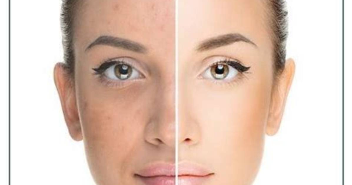 Is Vitamin E Good for Dark Spots?