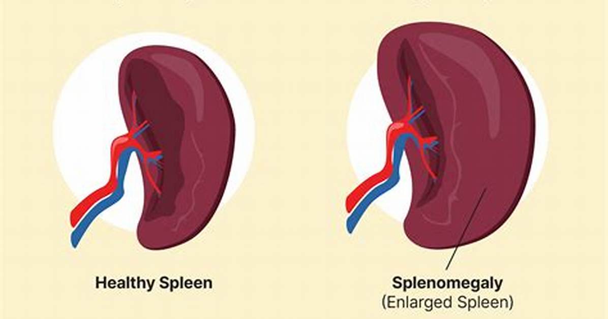 Is Water Good for Enlarged Spleen?