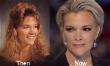 Megyn Kelly Plastic Surgery: Before & After Photos?