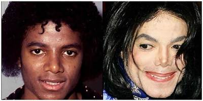 Michael Jackson Before and After Pepsi Accident Transformation