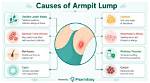 Morgpie Armpits: Understanding the Causes, Symptoms, and Treatment Options