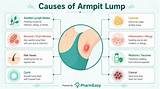 Morgpie Armpits: Understanding the Causes, Symptoms, and Treatment Options