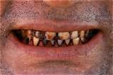 Nasty Teeth Smile: Understanding the Impact and Solutions