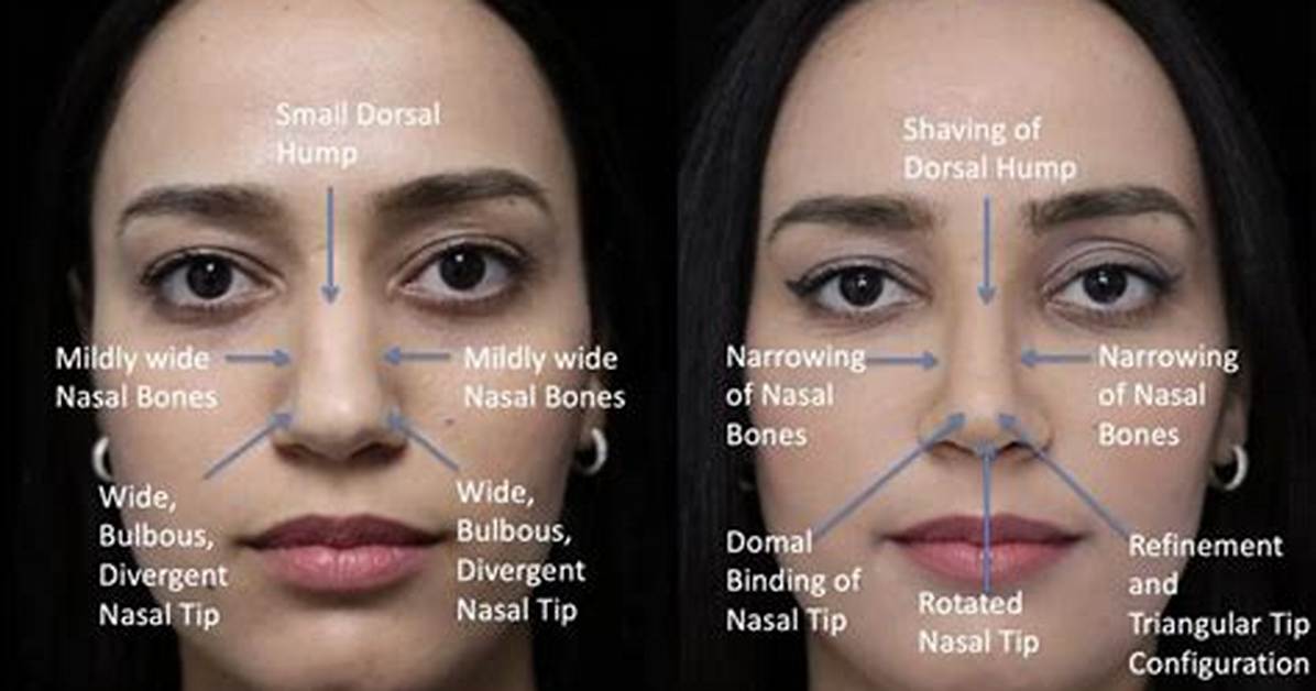 Nose Surgery and Botox Secrets