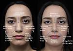 Nose Surgery and Botox Secrets