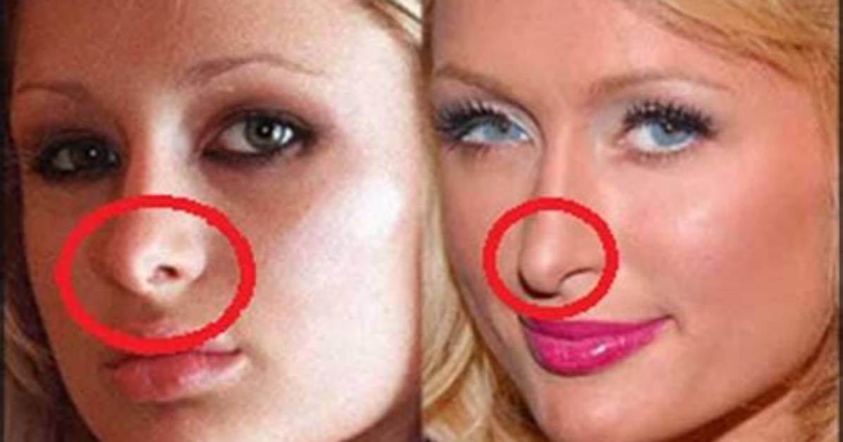 Paris Hilton S Nose Surgery a Before and After
