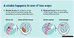 Pioneer Woman's Stroke: Updates & Resources