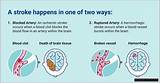 Pioneer Woman's Stroke: Updates & Resources