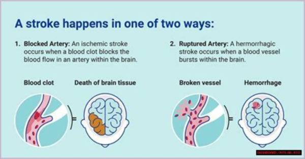 Pioneer Woman's Stroke: Updates & Resources