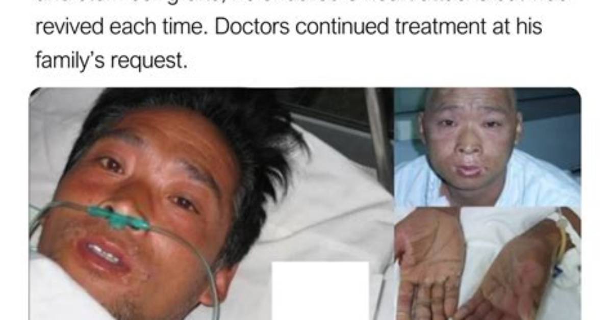 Remembering the Tragic Case of Hisashi Ouchi: a Devastating Radiation Accident