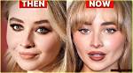 Sabrina Carpenter's Transformation: Before Fillers