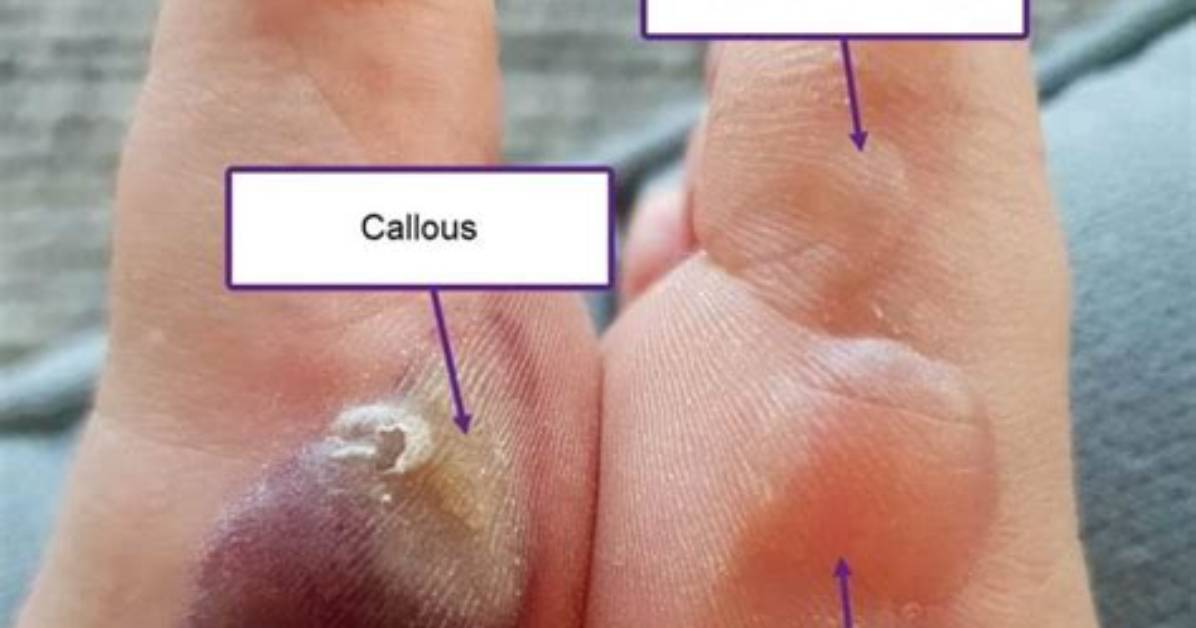 Should Blood Blisters Be Popped?