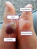 Should Blood Blisters Be Popped?