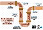 Should Bowel Movements Be Hard or Soft?