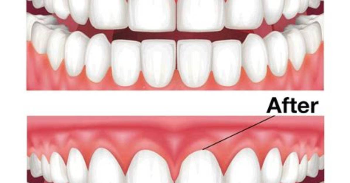 Should I Not Talk After Gum Graft?