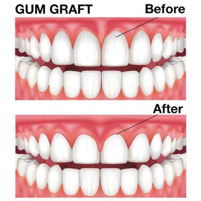 Should I Not Talk After Gum Graft?