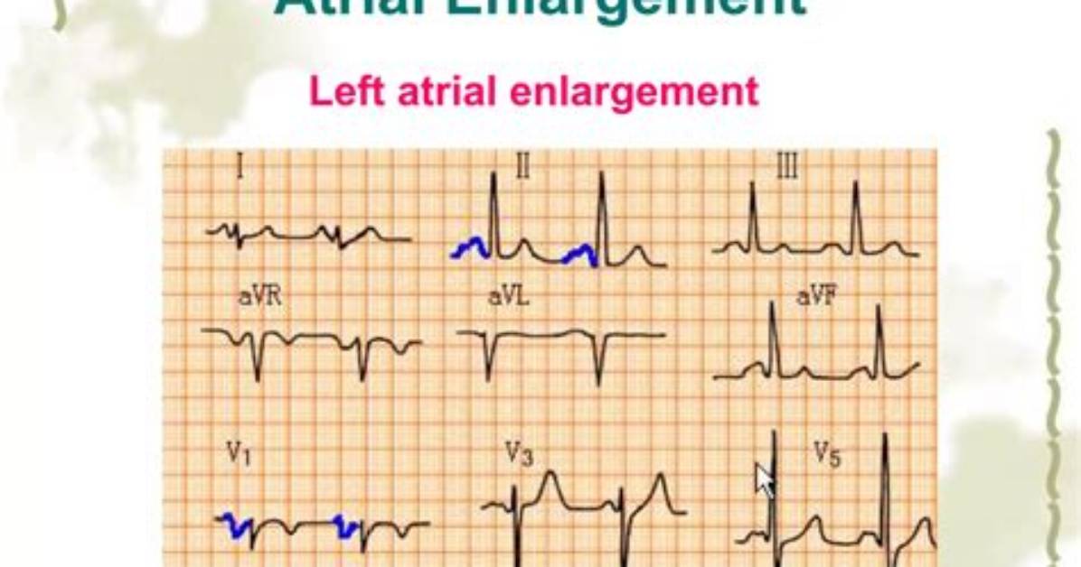 Should I Worry About Left Atrial Enlargement?