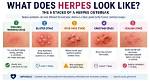Should You Pop Herpes Blisters? Understanding Risks, Treatments, and Prevention