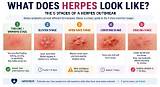 Should You Pop Herpes Blisters? Understanding Risks, Treatments, and Prevention