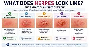 Should You Pop Herpes Blisters? Understanding Risks, Treatments, and Prevention