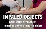 Should You Remove Impaled Object?