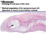 The Perils of Myxomatous Valve Disease: a Comprehensive Guide
