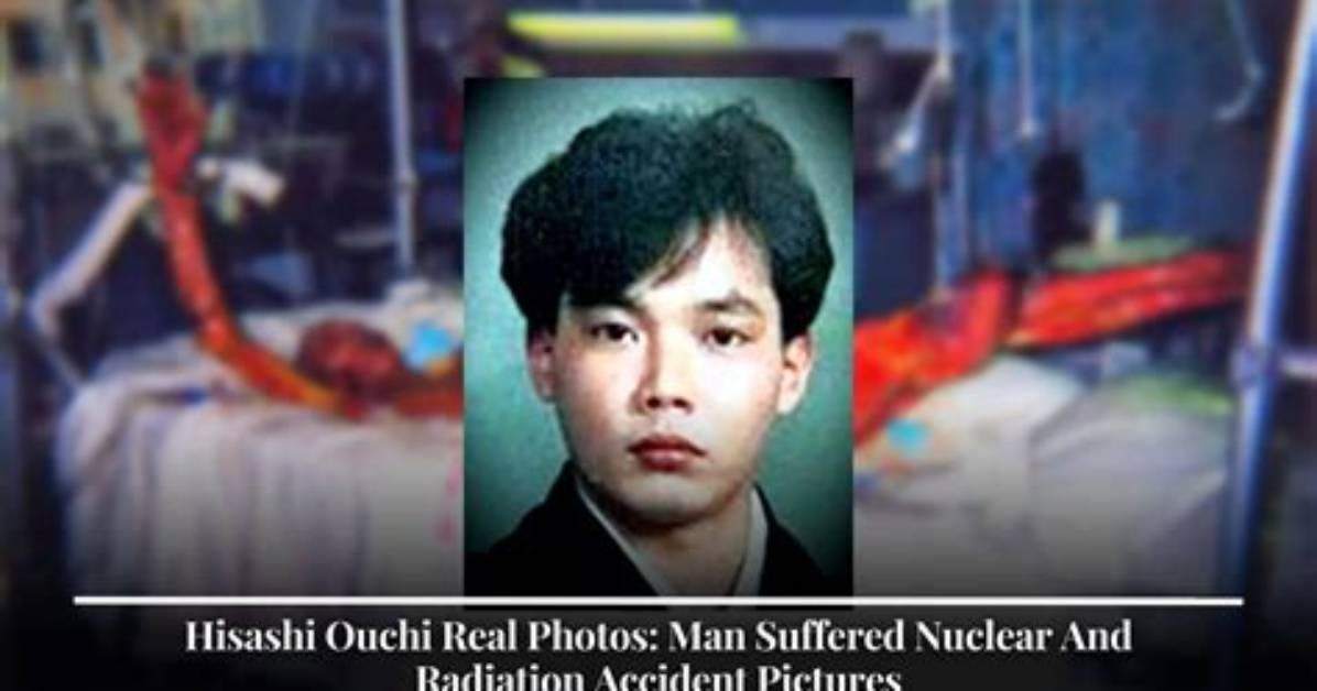 The Tragic Death of Hisashi Ouchi: a Cautionary Tale of Radiation Exposure