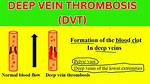 The Ultimate Guide to Dvt in the Leg: Icd-10 Codes Explained