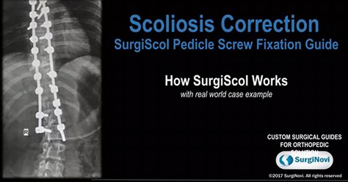 The Ultimate Guide to Scarless Scoliosis Surgery: Transform Your Spine Discreetly