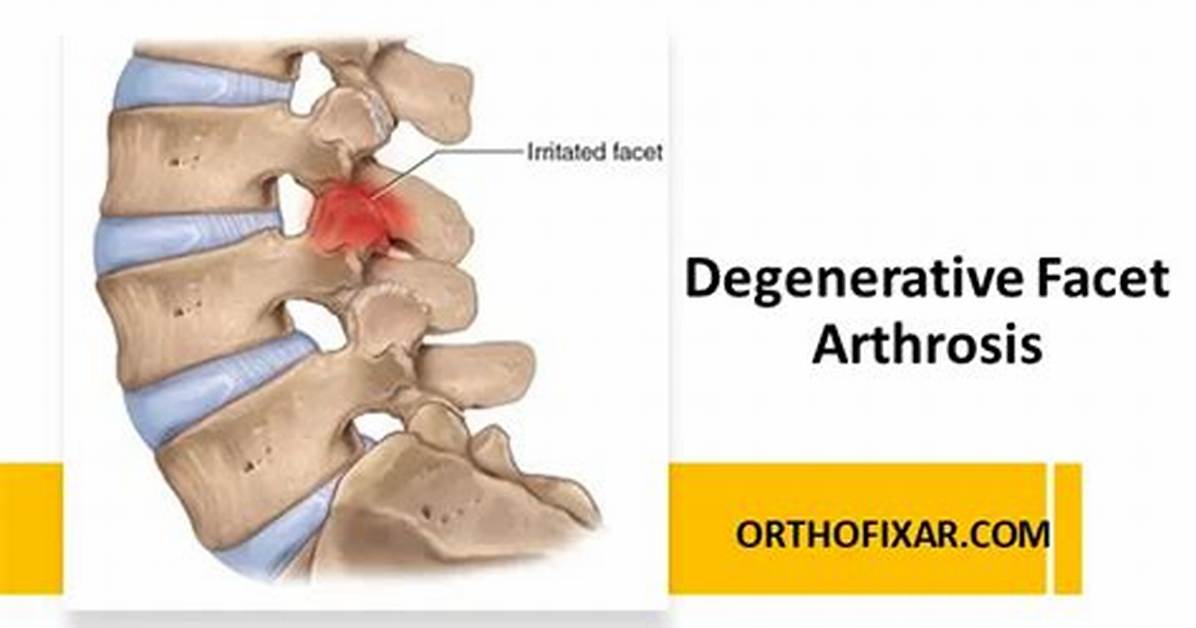 Ultimate Guide to Hypertrophic Facet Arthrosis Causes Symptoms And
