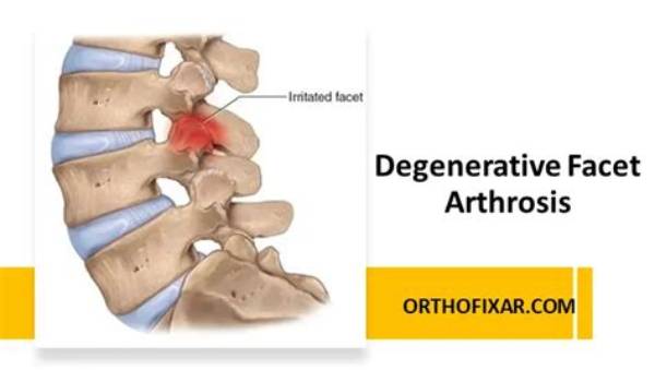 Ultimate Guide to Hypertrophic Facet Arthrosis: Causes, Symptoms, and Treatment