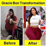 Understanding Gracie Bon's Medical Condition: a Comprehensive Overview