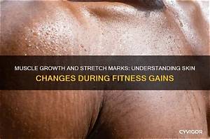 Understanding Stretch Marks and Muscle Growth: a Comprehensive Guide