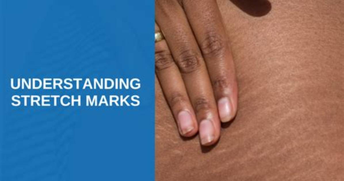 Understanding Stretch Marks: Causes, Prevention, and Treatment Options