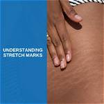 Understanding Stretch Marks: Causes, Prevention, and Treatment Options