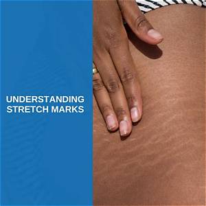 Understanding Stretch Marks: Causes, Prevention, and Treatment Options
