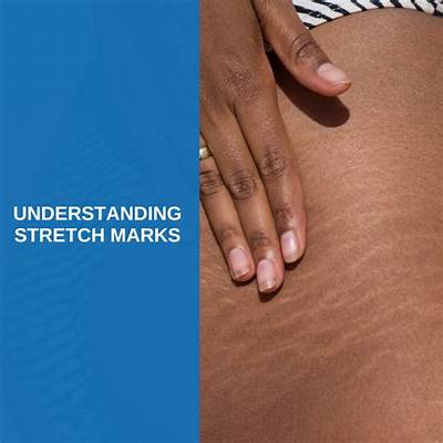 Understanding Stretch Marks: Causes, Prevention, and Treatment Options