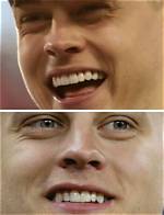 Unveiling the Truth: Joe Burrow's Veneers Journey