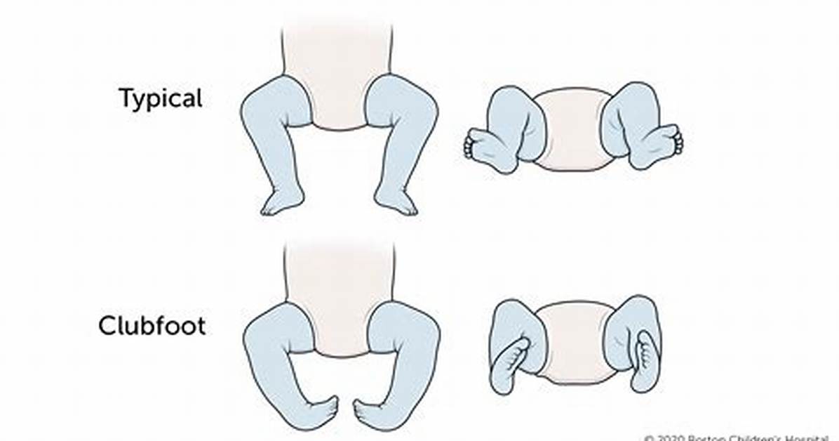 Was Born with Clubfoot?