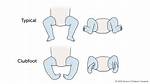Was Born with Clubfoot?