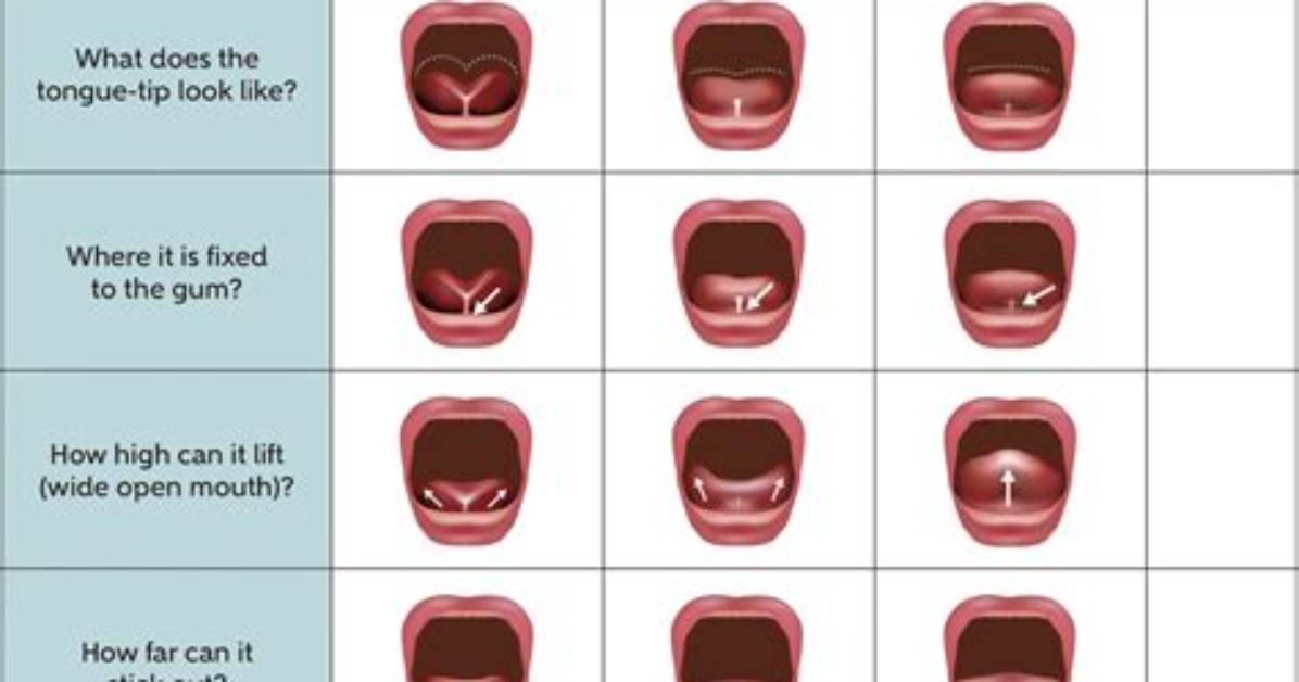 What Age Is Best for Tongue-Tie Surgery?