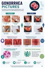 What Are Four Signs Symptoms of Gonorrhea?