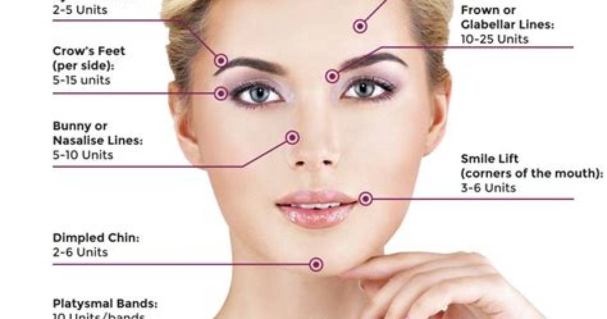 What Are the 4 Areas of Botox?