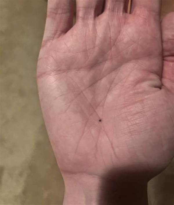 What Are the Black Dots on My Chin?